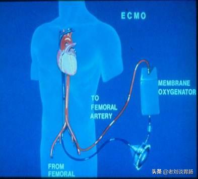 ecmo医学上是什么意思